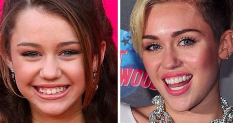 Miley Cyrus Teeth Before And After: From Gummy Smile To Perfect Veneers Rallshe