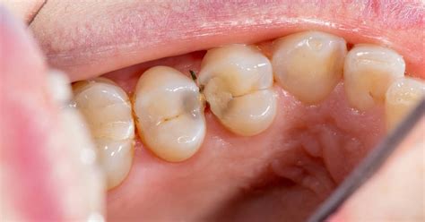 Cavity Side Of Molar