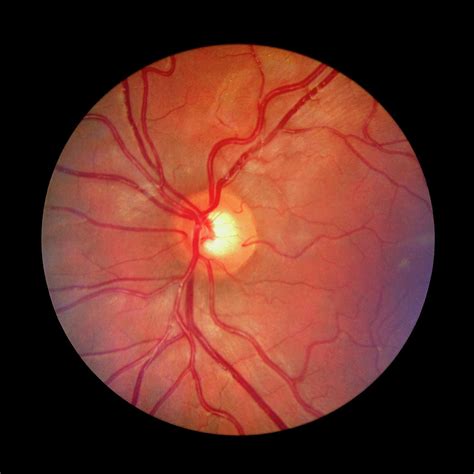 Fundus Camera Image Of A Normal Retina Photograph by Rory Mcclenaghan/science Photo Library - Pixels