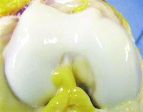 Gross image of articular cartilage on the femoral condyle of a healthy... | Download Scientific ...