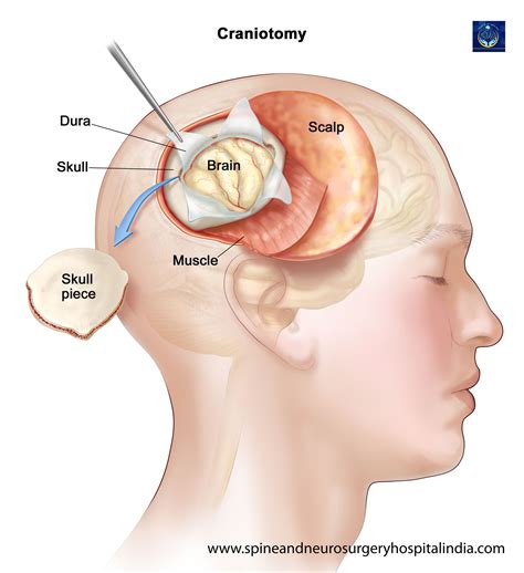 Craniectomy Surgery in India, Craniectomy Surgery Cost in India, Affordable Craniectomy Surgery ...