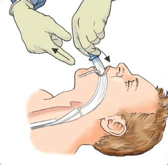 Laryngeal Mask Airway Insertion | Nurse Key