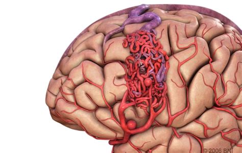 Arteriovenous Malformations - IRAN Health Tourism Organizer - Iran ...