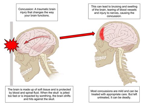 Concussions in rugby union - Wikipedia