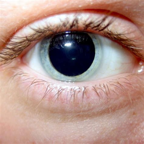 Dilated Pupils: Causes, Risks & Treatments