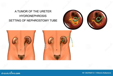Ein Tumor Des Ureter Hydronephrosis Einstellung Des Nephrostomy Rohrs Vektor Abbildung ...
