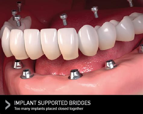 What Is A Bridge Teeth Procedure - Best Image Viajeperu.org