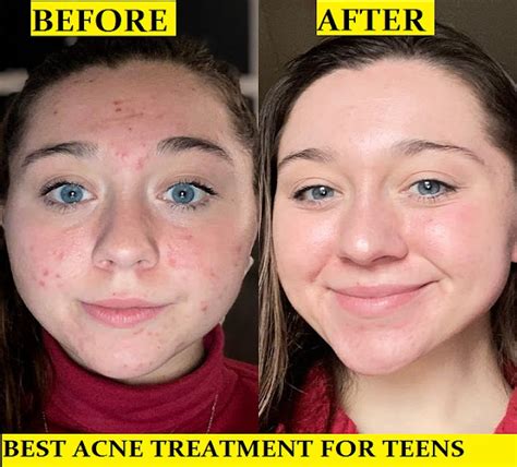 Best Acne Treatment For Teens - Finding the Best Acne Treatment For ...