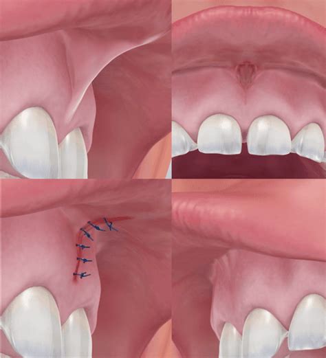 Upper labial frenulum - Dra. Vanesa Villamil