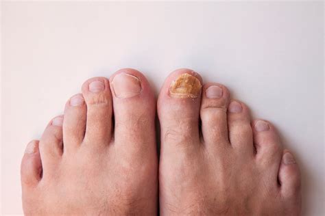 What Causes Toe Fungus