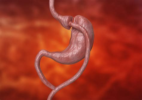 One Anastomosis Gastric Bypass in Patients With GERD, Hiatal Hernia - Gastroenterology Advisor