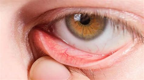 Meibomian Gland Dysfunction: Causes, Symptoms, and Management ...