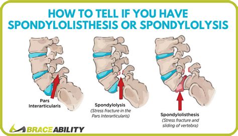 Do I Have Lumbar Spondylolisthesis or Spondylolysis?