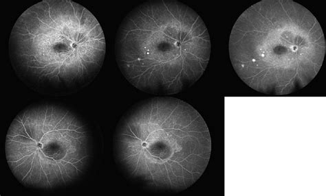 Distinguishing VKH From CSCR - Retina Today