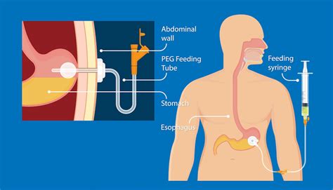 Feeding tubes — what you should know | Roswell Park Comprehensive ...