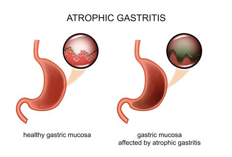 Atrophic Gastritis: Everything You Need to Know