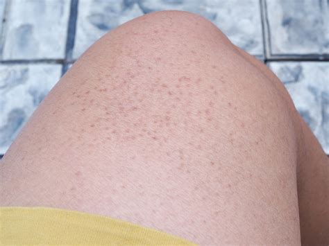 Gluten And Keratosis Pilaris AKA Chicken Skin Rash - Amy Burkhart, MD, RD