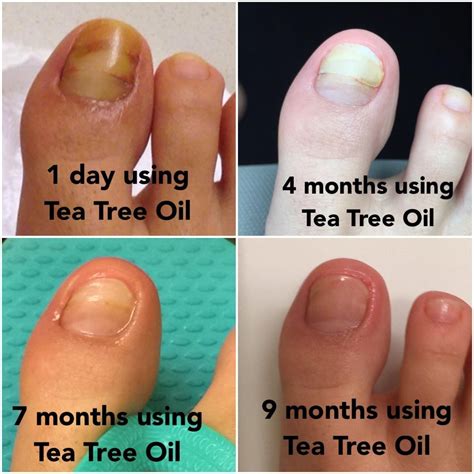 Amazon.com: Tea Tree Oil Foot Soak With Epsom Salt, Helps Treat Nail ...