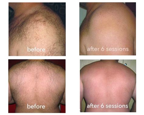 Brazilian Laser Hair Removal Before And After Photos - 2024 HairStyles ...