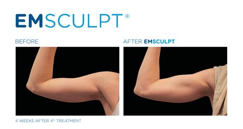 Results to Expect from Emsculpt Body Contouring Treatment - Just Melt ...