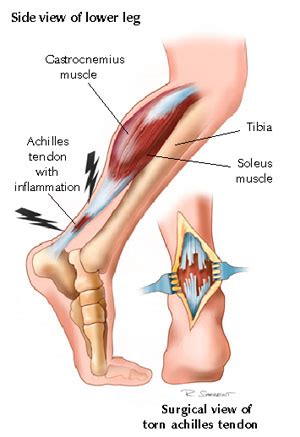 Achilles Tendon Anatomy