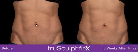 How Much is truSculpt iD Body Sculpting - Miami Skin Spa