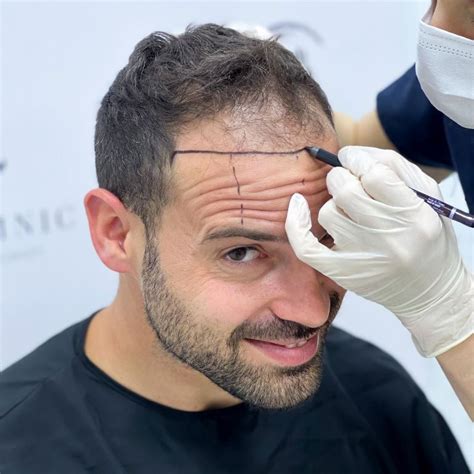 Hair Transplant for Receding Hairline - Heva Clinic