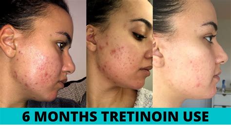 Tretinoin Sun Damage Cream (Retin-A) | ubicaciondepersonas.cdmx.gob.mx