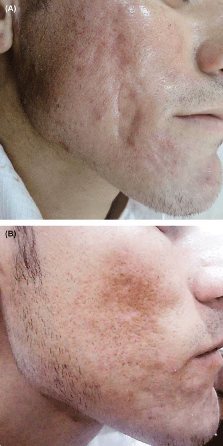 A male patient with Grade 4 acne scars and traumatic scars in Group C ...