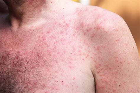 Heat Rash: Causes, Symptoms, Treatment and Prevention