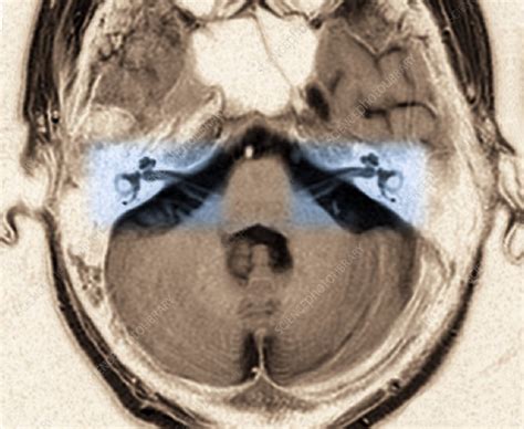 Auditory system, MRI - Stock Image - C023/9768 - Science Photo Library