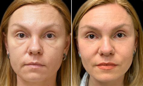Achieving Smooth Under-Eye Skin: Exploring the Efficacy of RF Microneedling for Treating Malar ...