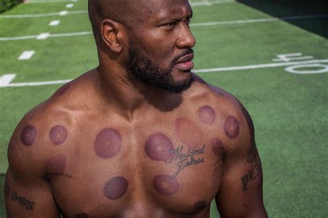 Pin on Celebrities Love Cupping