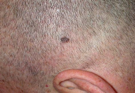 Melanoma scalp images | Symptoms and pictures