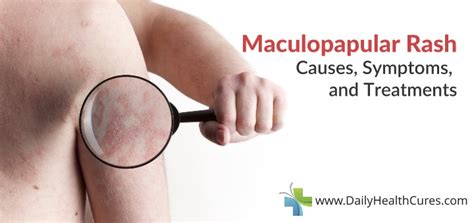 Maculopapular Rash: 6 Causes, Symptoms, and Home Remedies