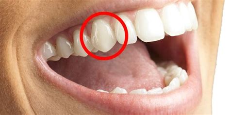 Why humans have sharp front teeth | Canine tooth, Teeth, Dental images