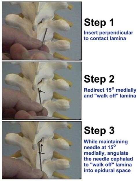 Pediatric Atlas of Ultrasound and Nerve Stimulation-Guided Regional Anesthesia - Chapter #33 ...