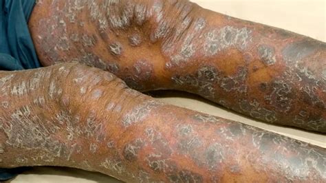 Psoriasis and Black Skin: Challenges and Effective Management Strategies - Flash Uganda Media