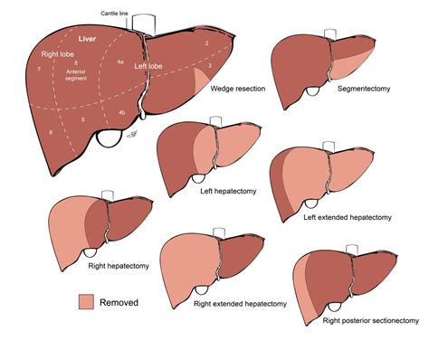 Liver Resection | Baylor Medicine