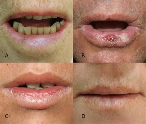 Actinic cheilitis causes, signs, symptoms, diagnosis, treatment & prognosis