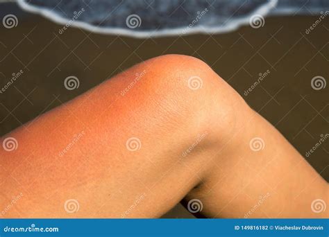 Woman Leg With Red Sunburn Skin On Seaside Background. Sunburned Skin Redness And Irritation ...