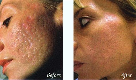 Laser Treatment of Acne Scars