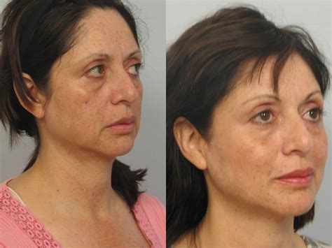 Theleafvacuum: Ultherapy Jowls Before And After
