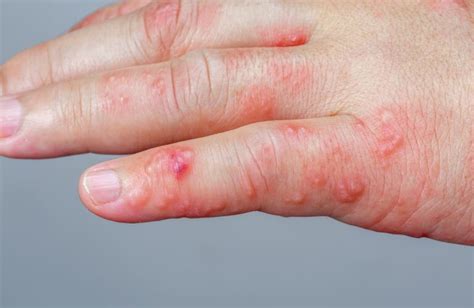 How Long Do Friction Burns Take To Heal - The severity of the rope burn ...