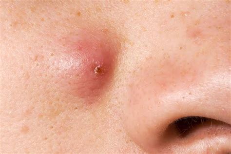 What Is Sebaceous Cyst? Symptoms And Causes - Home Natural Cures
