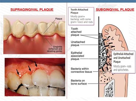 DENTAL PLAQUE - PART 1