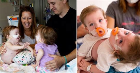 One-year-old conjoined twins successfully separated in 11-hour surgery | Metro News