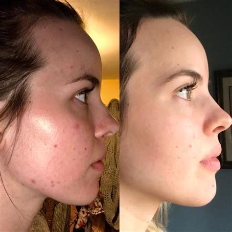 [B&A] 4 months on Aczone : r/SkincareAddiction