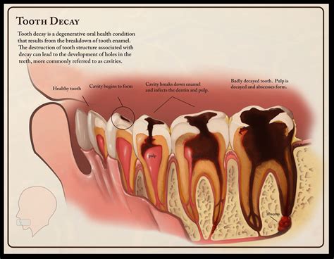 tooth decay | Tooth decay, Childrens dentist, Dental decay