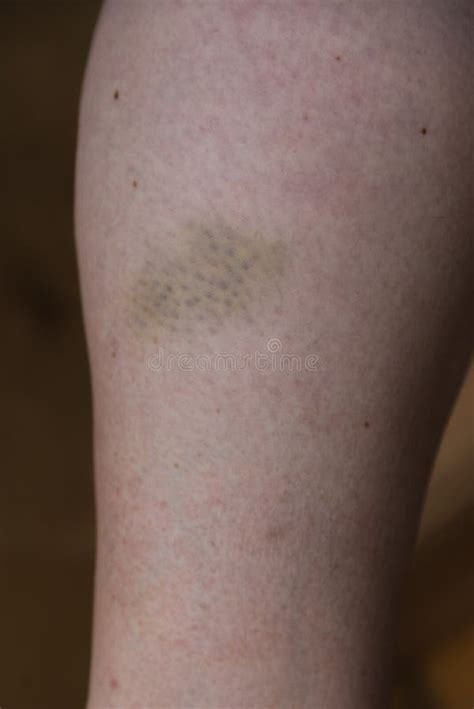 Bruise on the Lower Leg - Hematoma Stock Image - Image of bruise ...